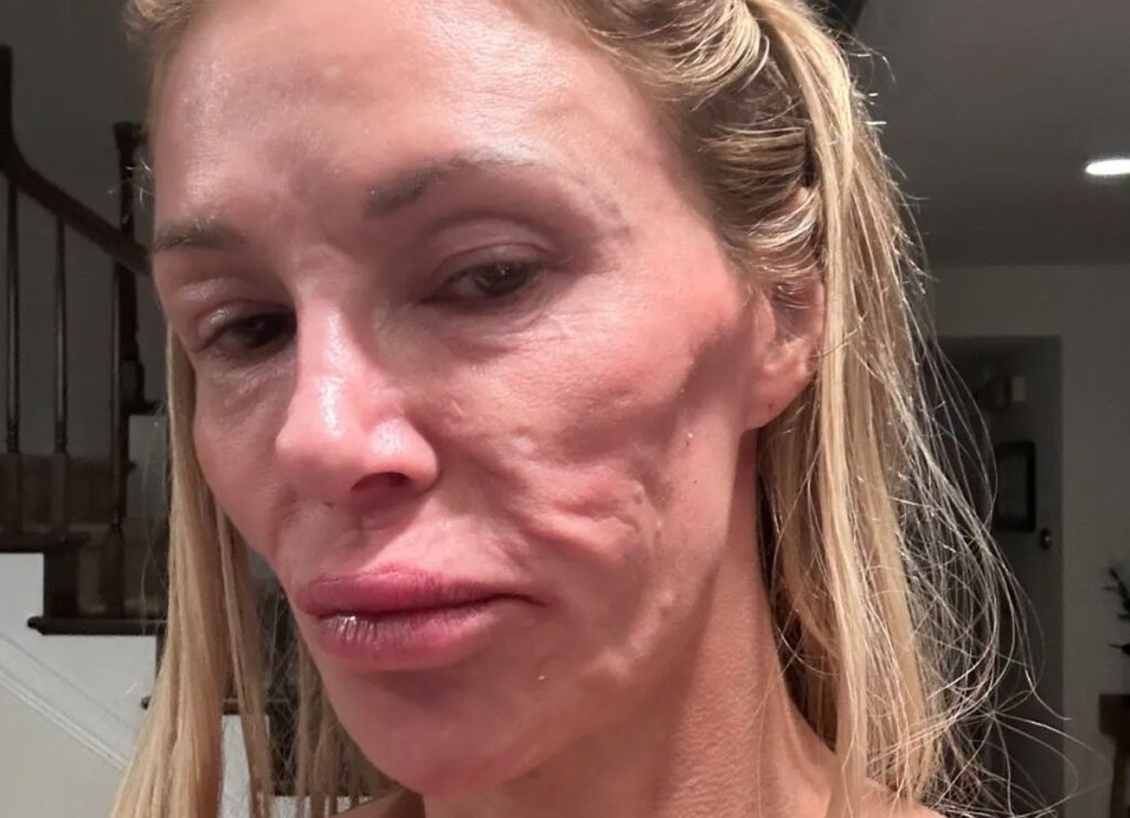 ‘Real Housewives’ Star Brandi Glanville Says Her Facial Disfigurement Is Result Of A Parasite – Not Plastic Surgery Gone Wrong