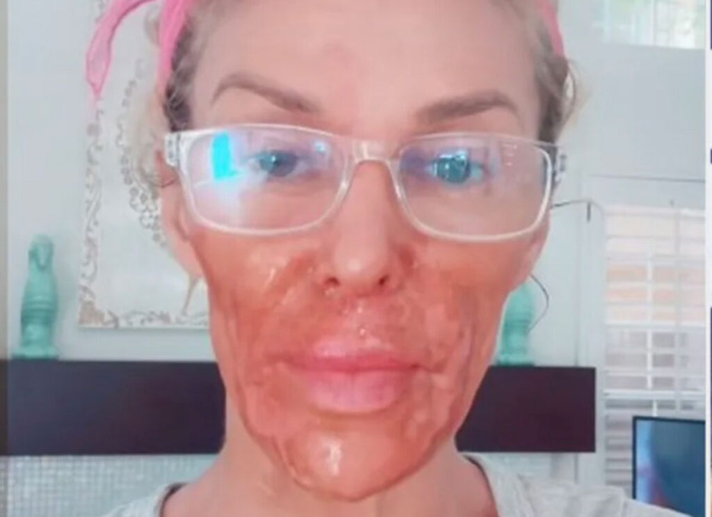 ‘Real Housewives’ Star Brandi Glanville Appears Badly Burned From New ‘Beauty Hack’ As She Battles Facial Parasites
